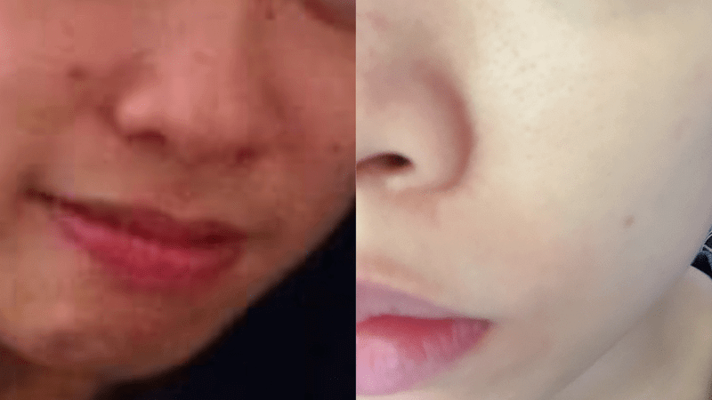 Skin Before after