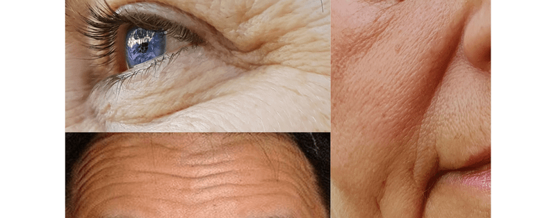 皮膚老化特徵
